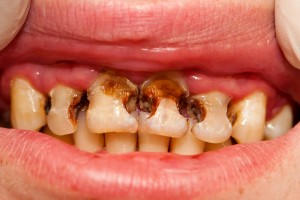 What Tooth Decay Looks Like in a Grownup Human Mouth