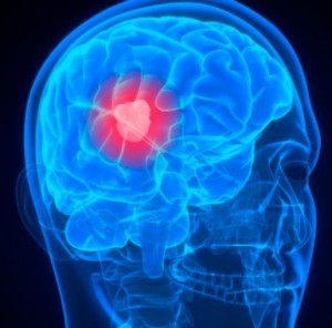 BRAIN CANCER