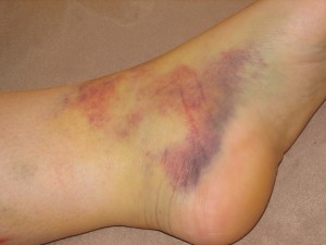 ANKLE SPRAIN