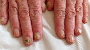 NAIL INFECTION1