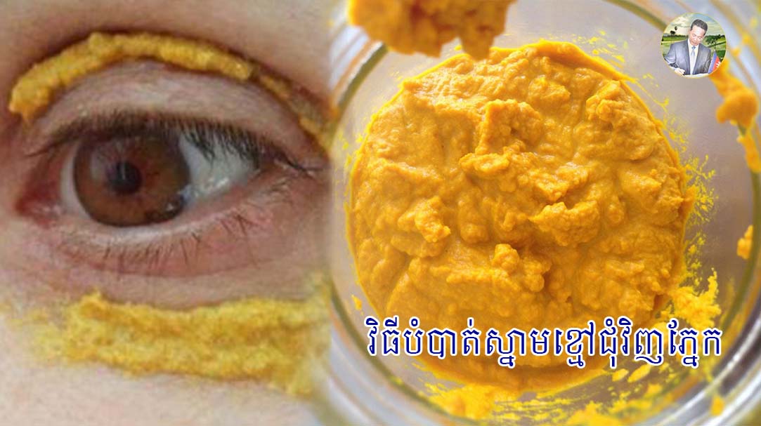 វិធីបំបាត់ស្នាមខ្មៅជុំវិញភ្នែក