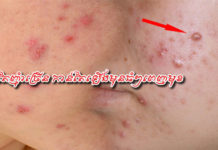 អាហារ នេះកាន់តែញុំាច្រើន កាន់តែឡើងមុនធំៗពេញមុខ!