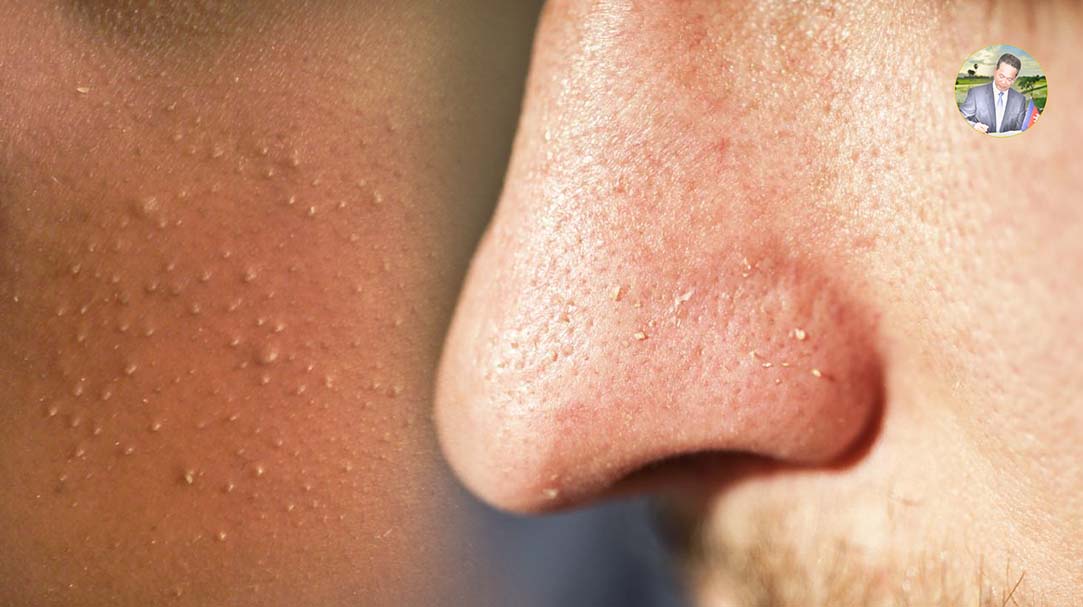 រូបមន្តធម្មជាតិបំបាត់មុនក្បាលសតូចៗលើផ្ទៃមុខ