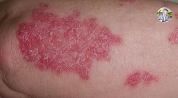 របៀបព្យាបាលជំងឺស្រែងដោយរូបមន្តធម្មជាតិ